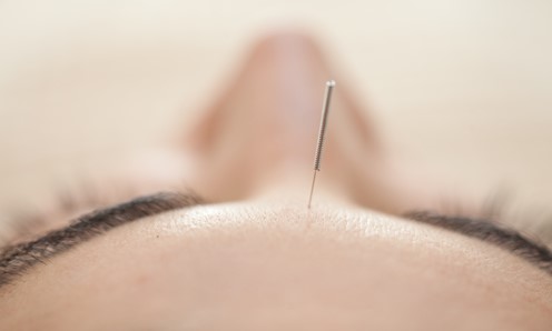 How can acupuncture help headaches?