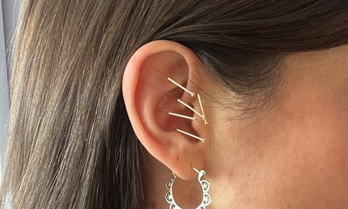 Auricular acupuncture & Ear Seeds